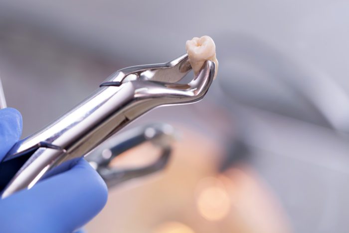 Tooth Extraction in Galveston, TX