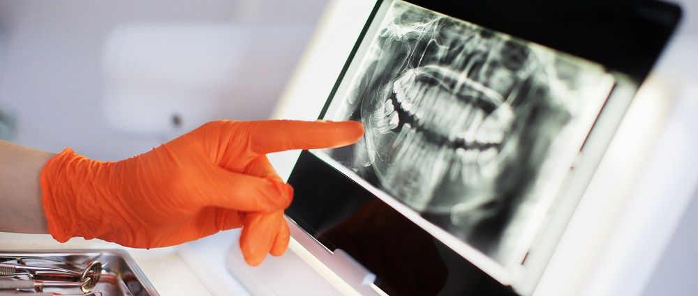 Technology in Root Canal Procedures
